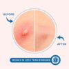 KEYCONCEPTS Pimple Patches for Face, Hydrocolloid Acne Patches with Tea Tree Oil - Pimple Patch Zit Patch and Pimple Stickers - Hydrocolloid Acne Dots for Acne - Zit Patches - Image 4